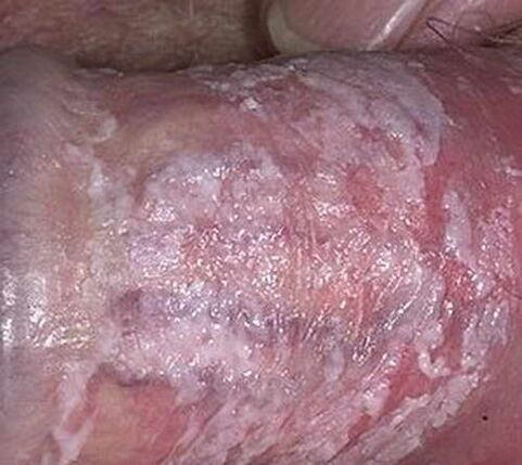 secrezione coagulata quando eccitato